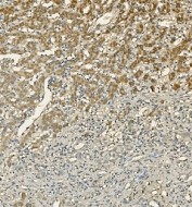 IHC staining of FFPE human liver cancer with Hepatic Lipase antibody. HIER: boil tissue sections in pH8 EDTA for 20 min and allow to cool before testing.