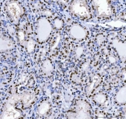 IHC staining of FFPE human thyroid cancer with Muscleblind-like 1 antibody. HIER: boil tissue sections in pH8 EDTA for 20 min and allow to cool before testing.