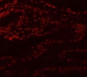 Immunofluorescent staining of FFPE human colon cancer with Muscleblind-like 1 antibody. HIER: steam section in pH6 citrate buffer for 20 min.