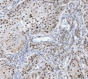 IHC staining of FFPE human laryngeal squamous cell carcinoma tissue with Muscleblind-like 1 antibody. HIER: boil tissue sections in pH8 EDTA for 20 min and allow to cool before testing.