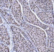 IHC staining of FFPE human liver cancer tissue with Muscleblind-like 1 antibody. HIER: boil tissue sections in pH8 EDTA for 20 min and allow to cool before testing.