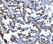 IHC staining of FFPE human ovarian serous adenocarcinoma tissue with Muscleblind-like 1 antibody. HIER: boil tissue sections in pH8 EDTA for 20 min and allow to cool before testing.