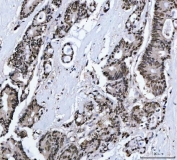 IHC staining of FFPE human colorectal adenocarcinoma tissue with Muscleblind-like 1 antibody. HIER: boil tissue sections in pH8 EDTA for 20 min and allow to cool before testing.