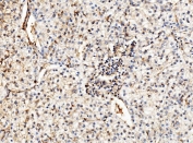 IHC staining of FFPE human liver cancer with Enolase 1 antibody. HIER: boil tissue sections in pH8 EDTA for 20 min and allow to cool before testing.