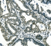 IHC staining of FFPE human rectum cancer with Msi1 antibody. HIER: boil tissue sections in pH8 EDTA for 20 min and allow to cool before testing.
