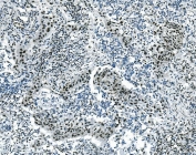 IHC staining of FFPE human lung cancer with Msi1 antibody. HIER: boil tissue sections in pH8 EDTA for 20 min and allow to cool before testing.