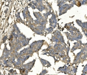 IHC staining of FFPE human ovarian cancer with BUB1B antibody. HIER: boil tissue sections in pH8 EDTA for 20 min and allow to cool before testing.