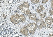 IHC staining of FFPE human breast cancer with BUB1B antibody. HIER: boil tissue sections in pH8 EDTA for 20 min and allow to cool before testing.