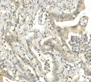 IHC staining of FFPE human rectal cancer with BUB1B antibody. HIER: boil tissue sections in pH8 EDTA for 20 min and allow to cool before testing.