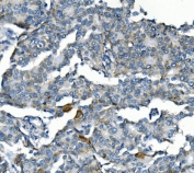 IHC staining of FFPE human breast cancer with Cyclin B2 antibody. HIER: boil tissue sections in pH8 EDTA for 20 min and allow to cool before testing.