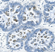 IHC staining of FFPE human ovarian cancer with Cyclin B2 antibody. HIER: boil tissue sections in pH8 EDTA for 20 min and allow to cool before testing.