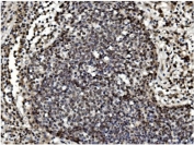 IHC staining of FFPE human lung cancer with TET1 antibody. HIER: boil tissue sections in pH8 EDTA for 20 min and allow to cool before testing.