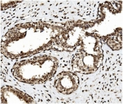 IHC staining of FFPE human breast cancer with TET1 antibody. HIER: boil tissue sections in pH8 EDTA for 20 min and allow to cool before testing.
