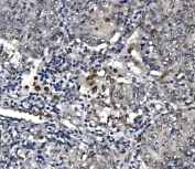 IHC staining of FFPE human lung cancer with POLR2A antibody. HIER: boil tissue sections in pH8 EDTA for 20 min and allow to cool before testing.