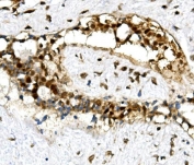 IHC staining of FFPE human breast cancer with U2AF65 antibody. HIER: boil tissue sections in pH8 EDTA for 20 min and allow to cool before testing.