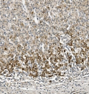 IHC staining of FFPE human liver cancer with Sprouty 4 antibody. HIER: boil tissue sections in pH8 EDTA for 20 min and allow to cool before testing.