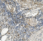 IHC staining of FFPE human rectal cancer with Sprouty 4 antibody. HIER: boil tissue sections in pH8 EDTA for 20 min and allow to cool before testing.