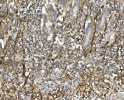 IHC staining of FFPE human rectal cancer with Sprouty 4 antibody. HIER: boil tissue sections in pH8 EDTA for 20 min and allow to cool before testing.