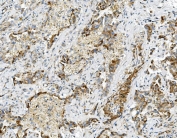IHC staining of FFPE human lung cancer with USP16 antibody. HIER: boil tissue sections in pH8 EDTA for 20 min and allow to cool before testing.