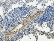 IHC staining of FFPE human lung cancer with Vinculin antibody. HIER: boil tissue sections in pH8 EDTA for 20 min and allow to cool before testing.