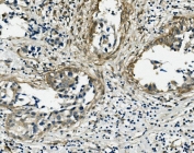 IHC staining of FFPE human breast cancer with Vinculin antibody. HIER: boil tissue sections in pH8 EDTA for 20 min and allow to cool before testing.