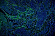 Immunofluorescent staining of FFPE human breast cancer tissue with Vinculin antibody (green) and DAPI nuclear stain (blue). HIER: steam section in pH6 citrate buffer for 20 min.