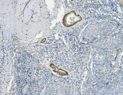 IHC staining of FFPE human lung cancer with Vinculin antibody. HIER: boil tissue sections in pH8 EDTA for 20 min and allow to cool before testing.