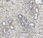 IHC staining of FFPE human breast cancer with CTHRC1 antibody. HIER: boil tissue sections in pH8 EDTA for 20 min and allow to cool before testing.