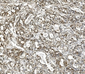 IHC staining of FFPE human stomach cancer with GLS antibody. HIER: boil tissue sections in pH8 EDTA for 20 min and allow to cool before testing.