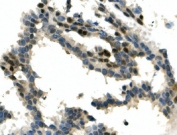 IHC staining of FFPE human breast cancer with AIP4 antibody. HIER: boil tissue sections in pH8 EDTA for 20 min and allow to cool before testing.