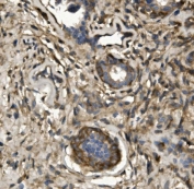 IHC staining of FFPE human breast cancer with MYH10 antibody. HIER: boil tissue sections in pH8 EDTA for 20 min and allow to cool before testing.