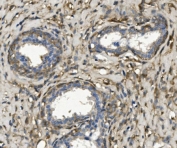 IHC staining of FFPE human breast cancer with MYH10 antibody. HIER: boil tissue sections in pH8 EDTA for 20 min and allow to cool before testing.