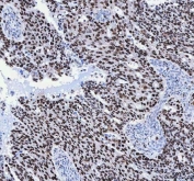 IHC staining of FFPE human ovarian serous adenocarcinoma with FEN-1 antibody. HIER: boil tissue sections in pH8 EDTA for 20 min and allow to cool before testing.