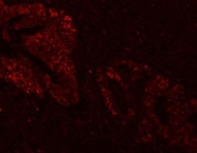 Immunofluorescent staining of FFPE human intestinal cancer tissue with FEN-1 antibody. HIER: steam section in pH8 EDTA buffer for 20 min.