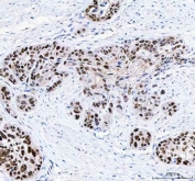 IHC staining of FFPE human esophageal squamous carcinoma with FEN-1 antibody. HIER: boil tissue sections in pH8 EDTA for 20 min and allow to cool before testing.