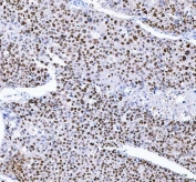 IHC staining of FFPE human liver cancer with FEN-1 antibody. HIER: boil tissue sections in pH8 EDTA for 20 min and allow to cool before testing.