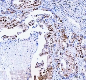 IHC staining of FFPE human lung adenocarcinoma with FEN-1 antibody. HIER: boil tissue sections in pH8 EDTA for 20 min and allow to cool before testing.