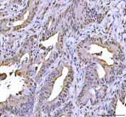 IHC staining of FFPE human rectal cancer with FEN-1 antibody. HIER: boil tissue sections in pH8 EDTA for 20 min and allow to cool before testing.