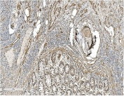 IHC staining of FFPE human rectal cancer with CAV2 antibody. HIER: boil tissue sections in pH8 EDTA for 20 min and allow to cool before testing.