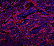 Immunofluorescent staining of FFPE human intestinal cancer with CAV2 antibody (red) and DAPI nuclear stain (blue). HIER: steam section in pH8 EDTA buffer for 20 min.