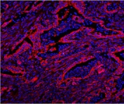 Immunofluorescent staining of FFPE human intestinal cancer with CAV2 antibody (red) and DAPI nuclear stain (blue). HIER: steam section in pH8 EDTA buffer for 20 min.