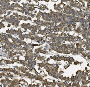 IHC staining of FFPE human breast cancer with ALDH1L1 antibody. HIER: boil tissue sections in pH8 EDTA for 20 min and allow to cool before testing.