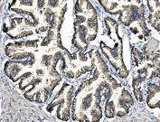 IHC staining of FFPE human prostate cancer with Arginase 2 antibody. HIER: boil tissue sections in pH8 EDTA for 20 min and allow to cool before testing.