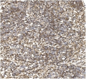 IHC staining of FFPE human lung cancer with BDH1 antibody. HIER: boil tissue sections in pH8 EDTA for 20 min and allow to cool before testing.