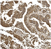 IHC staining of FFPE human rectal cancer with BDH1 antibody. HIER: boil tissue sections in pH8 EDTA for 20 min and allow to cool before testing.