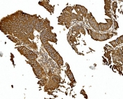 IHC staining of FFPE human rectal cancer with BDH1 antibody. HIER: boil tissue sections in pH8 EDTA for 20 min and allow to cool before testing.