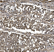 IHC staining of FFPE human gastric cancer with MitoNEET antibody. HIER: boil tissue sections in pH8 EDTA for 20 min and allow to cool before testing.
