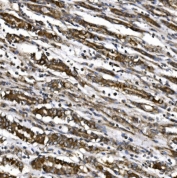 IHC staining of FFPE human gastric cancer with MitoNEET antibody. HIER: boil tissue sections in pH8 EDTA for 20 min and allow to cool before testing.