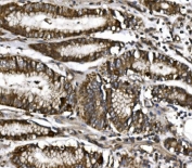 IHC staining of FFPE human gastric cancer with MitoNEET antibody. HIER: boil tissue sections in pH8 EDTA for 20 min and allow to cool before testing.