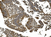 IHC staining of FFPE human rectal cancer with MitoNEET antibody. HIER: boil tissue sections in pH8 EDTA for 20 min and allow to cool before testing.